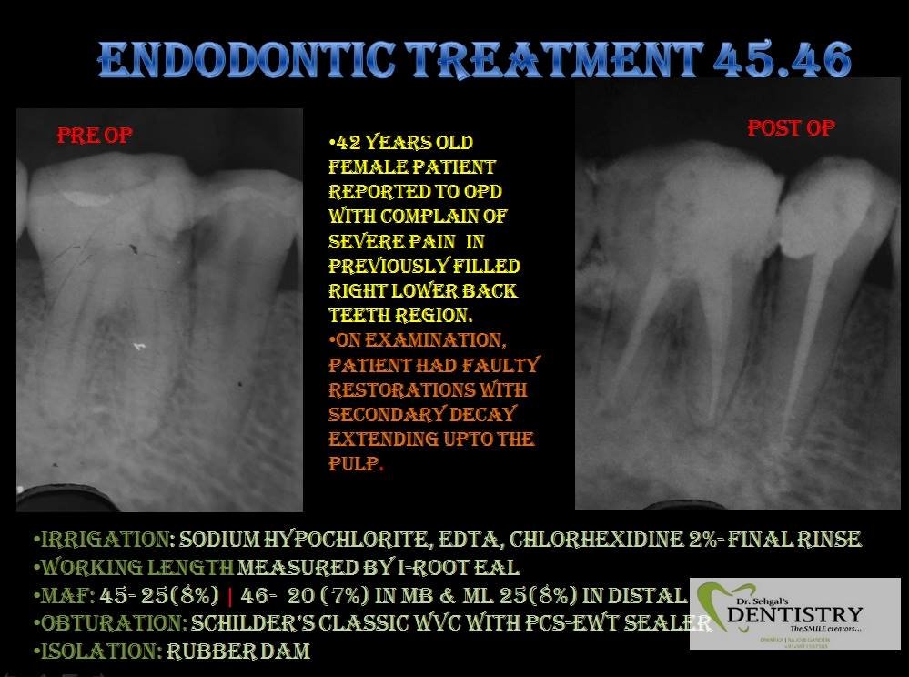 RCT DENTAL PROFESSIONALS ENDO 45,46 The Dental Daily
