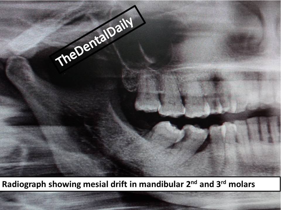 Mesial Drift by Dr. Triveni Padale The Dental Daily